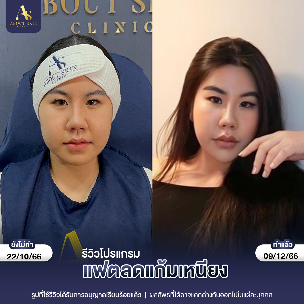 คุณกัน แฟตแก้ม 22_10_66