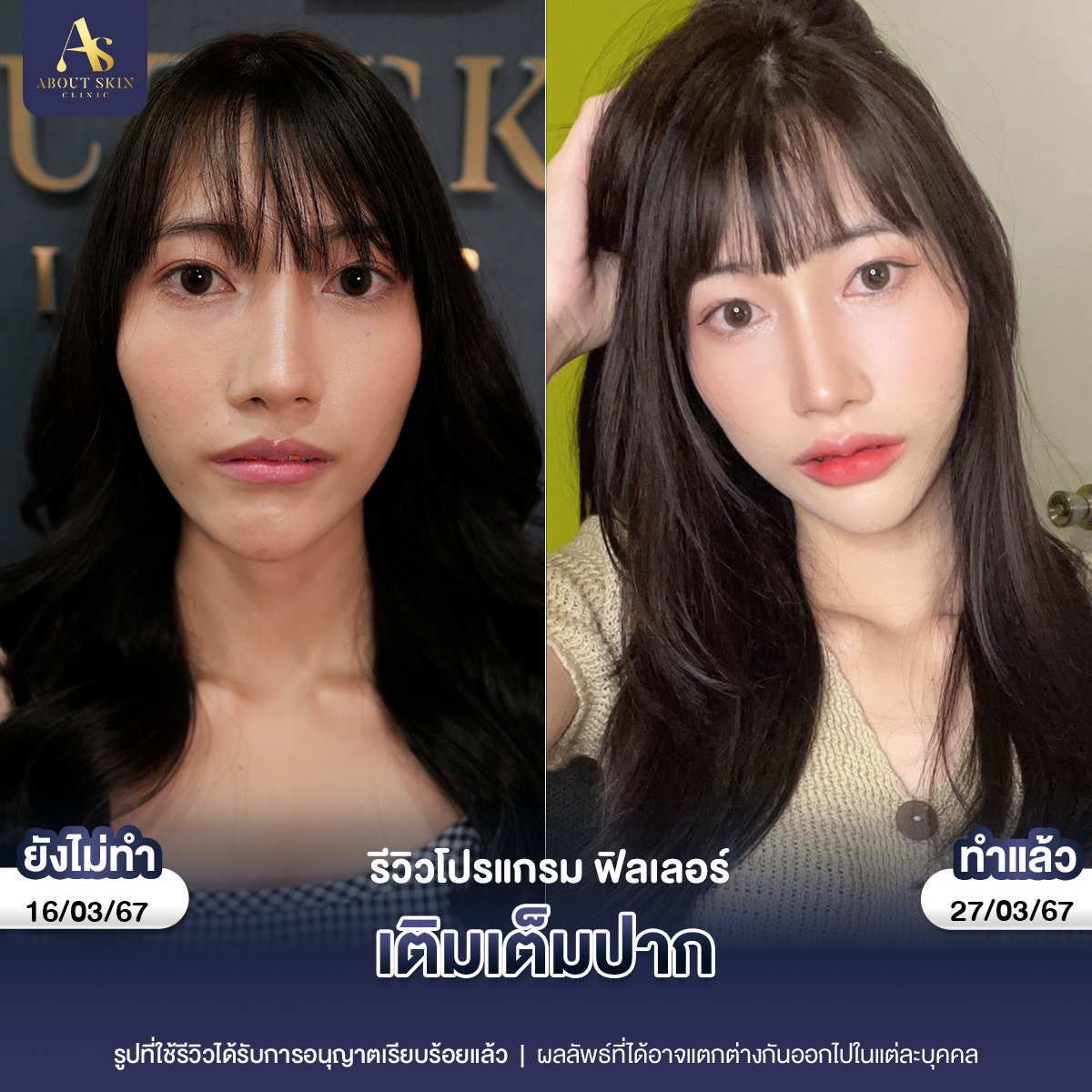 คุณบีวี่ ฟิลเลอร์ปาก_