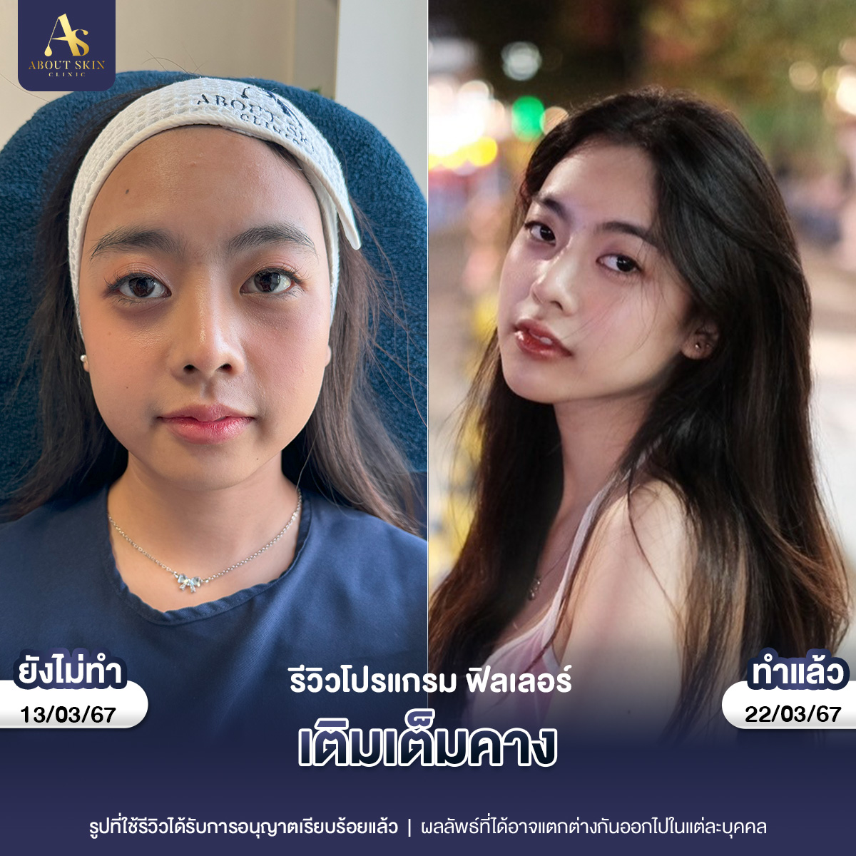 คุณหยก ฟิลเลอร์คาง-1