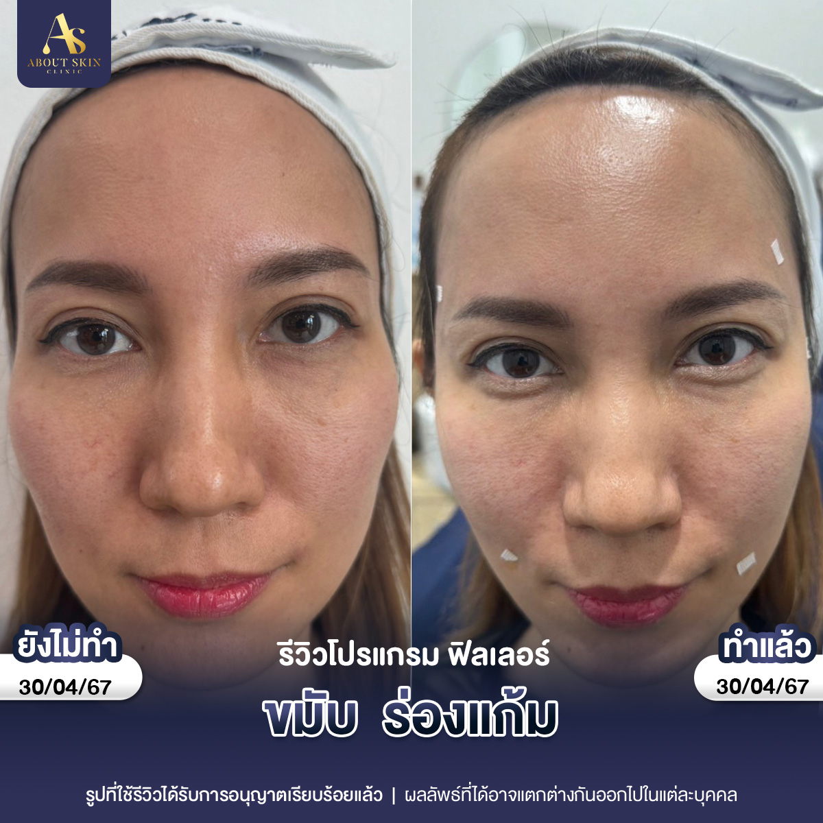 คุณหยก ฟิลเลอร์คาง