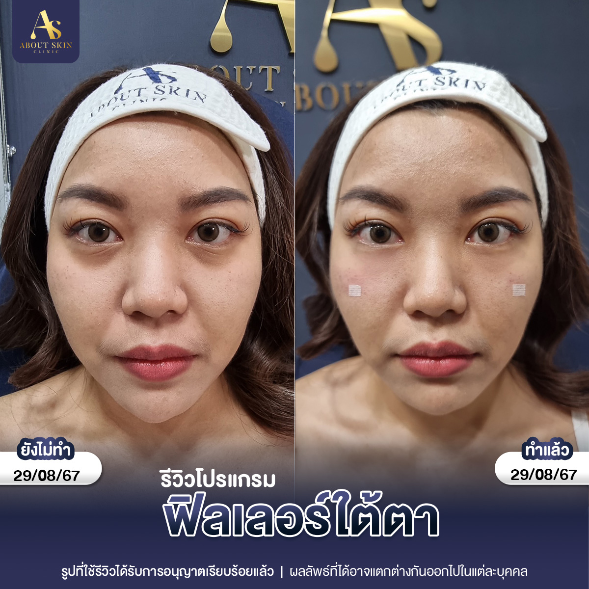 คุณเกล ฟิลเลอร์ปาก 11_07_67 copy