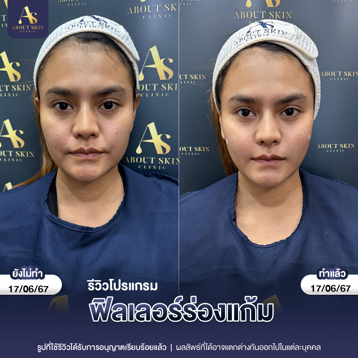 คุณแป้ง ฟิลเลอร์ร่องแก้ม 11_03_67