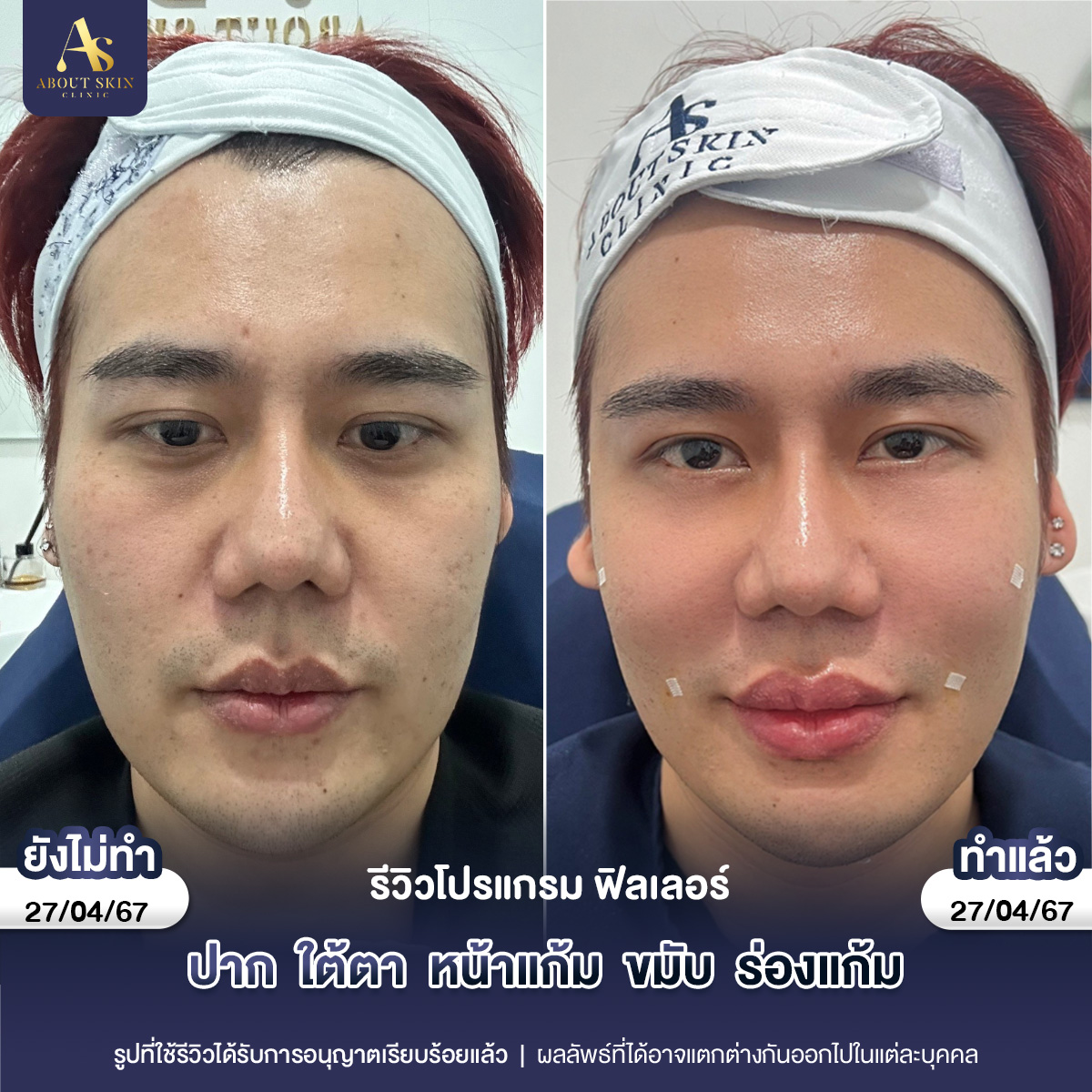 โต๋ ฟิลเลอร์ 27_04_67