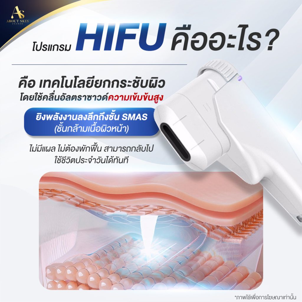 โปรแกรม HIFU คืออะไร