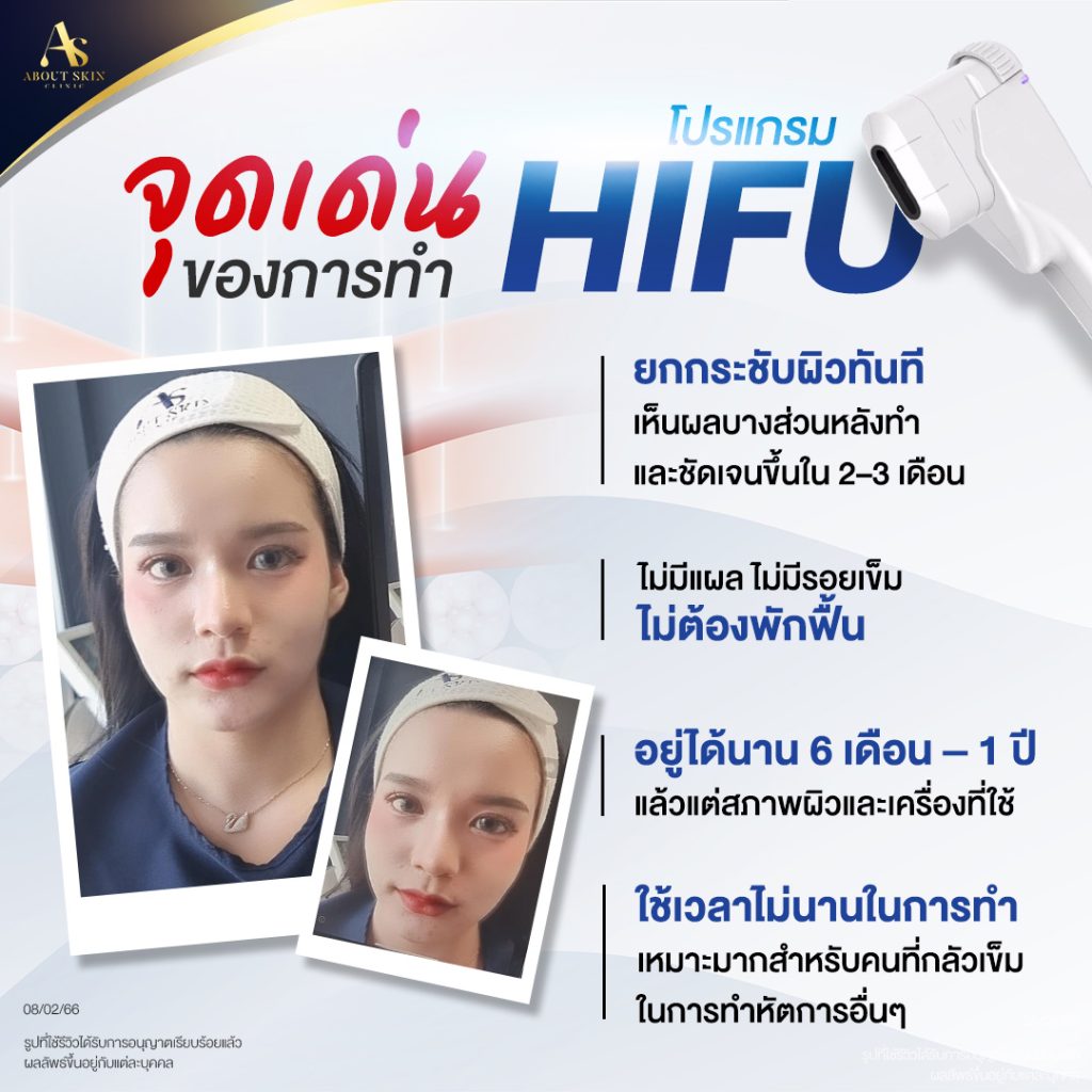 จุดเด่นของ HIFU