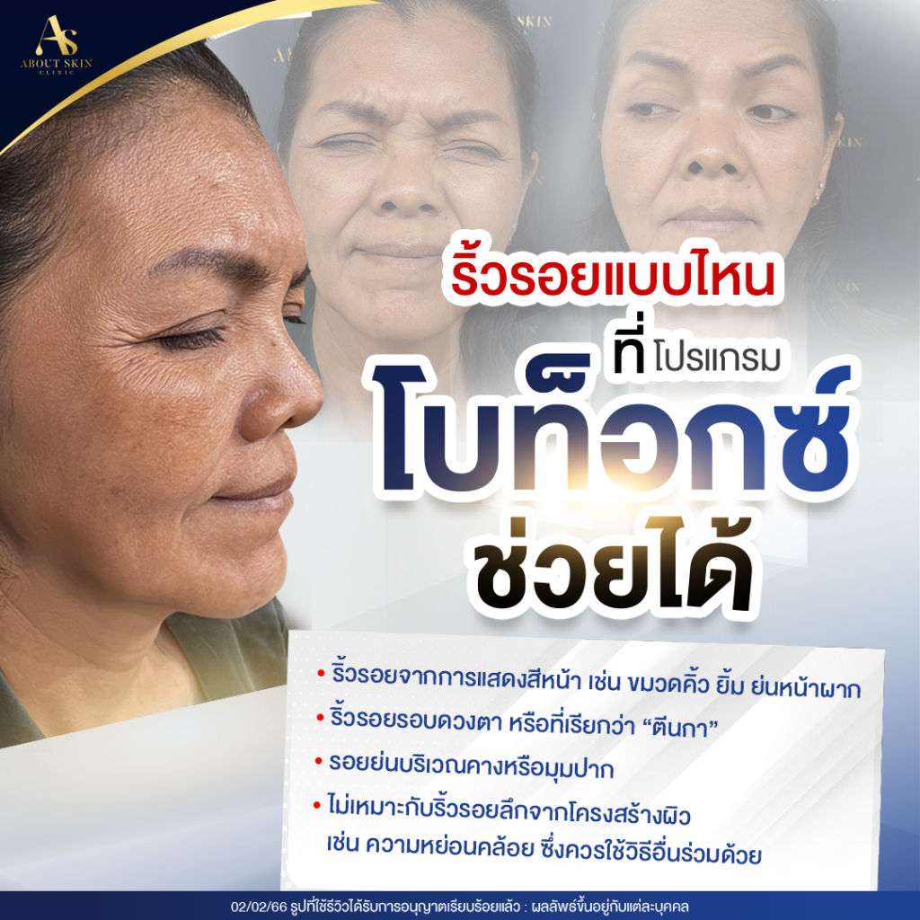 AB-June-3-2 ริ้วรอยแบบไหนที่โปรแกรมโบท็อกซ์ช่วยได้
