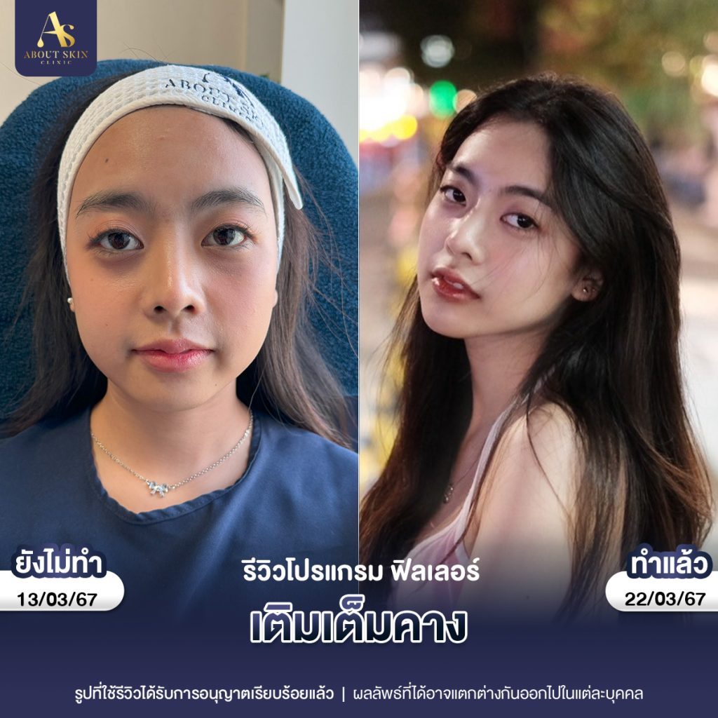 คุณหยก ฟิลเลอร์คาง-1