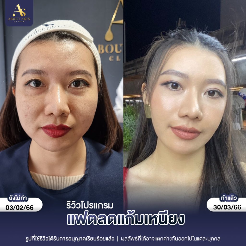 คุณองุ่น แฟต+โบกราม 03_02_66