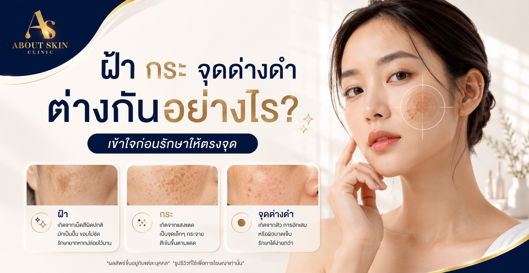 ฝ้า กระ จุดด่างดำ ต่างกันอย่างไร