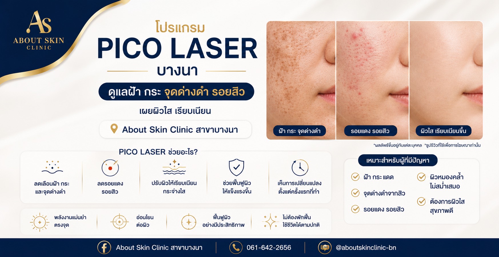 Pico Laser ดูแลฝ้า กระ จุดด่างดำ ที่ About Skin Clinic สาขาบางนา