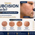 Subcision หรือ การตัดพังผืดหลุมสิว คืออะไร
