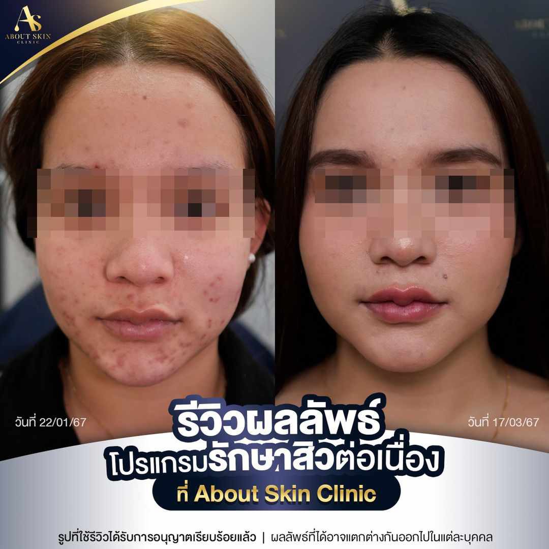 รีวิวผลลัพธ์โปรแกรมรักษาสิวต่อเนื่อง About Skin Clinic