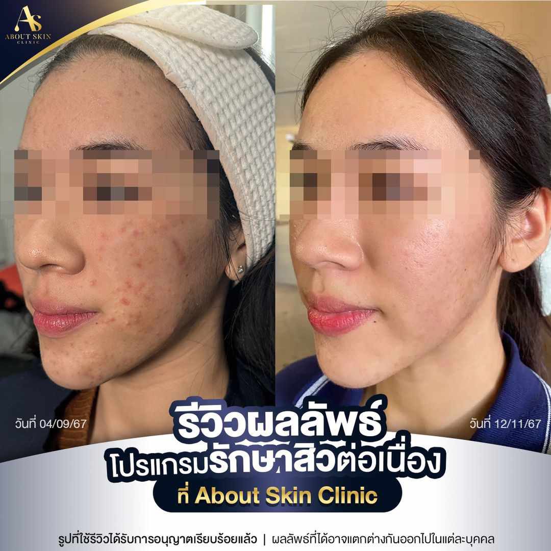 รีวิวผลลัพธ์โปรแกรมรักษาสิวต่อเนื่อง About Skin Clinic