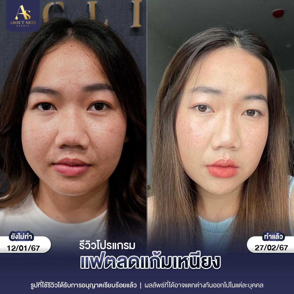 รีวิวโปรแกรมแฟตลดแก้มเหนียว About Skin Clinic