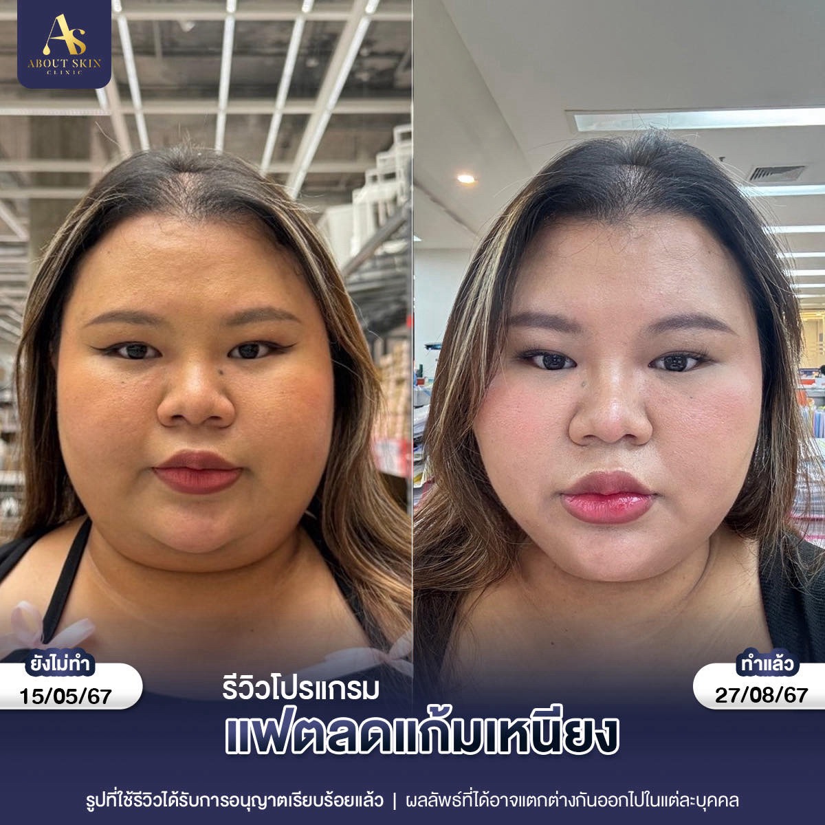 รีวิวโปรแกรมแฟตลดแก้มเหนียว About Skin Clinic