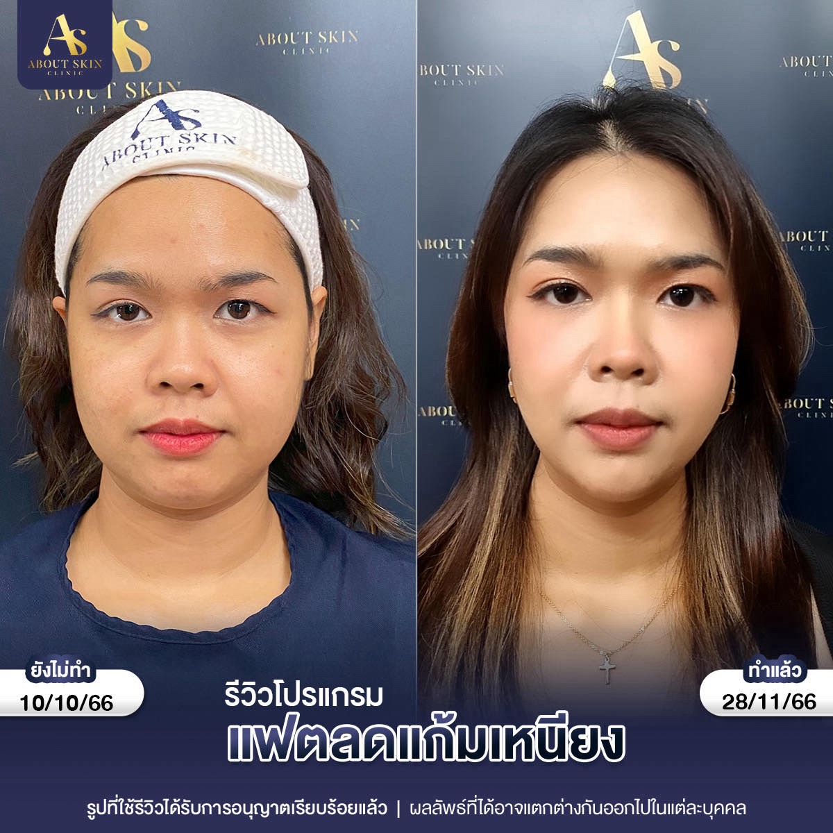 รีวิวโปรแกรมแฟตลดแก้มเหนียว About Skin Clinic