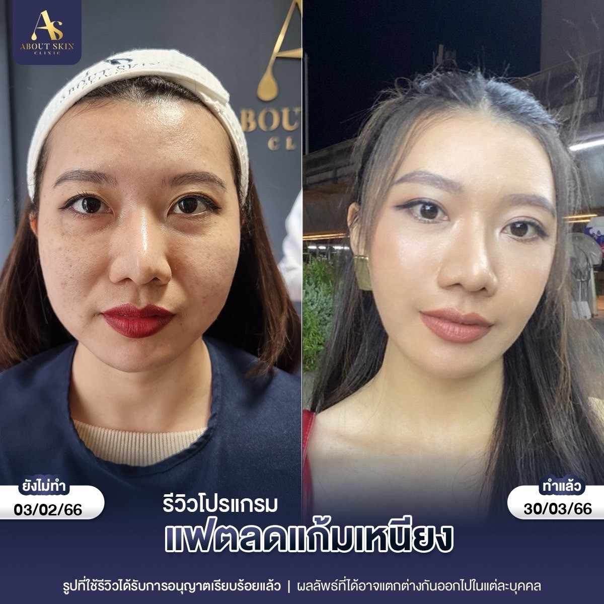 รีวิวโปรแกรมแฟตลดแก้มเหนียว About Skin Clinic