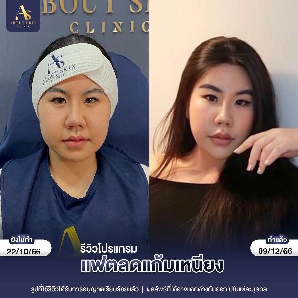 รีวิวโปรแกรมแฟตลดแก้มเหนียว About Skin Clinic