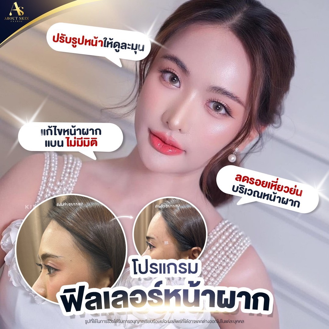 โปรแกรมฟิลเลอร์หน้าผาก About Skin Clinic