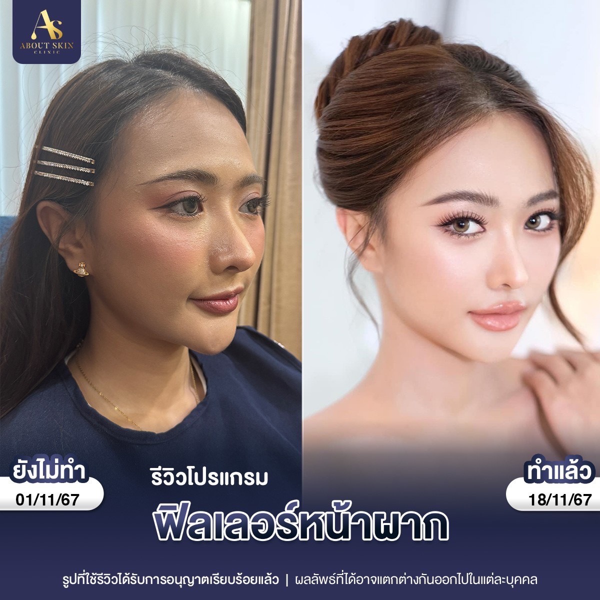 รีวิวโปรแกรมฟิลเลอร์หน้าผาก About Skin Clinic