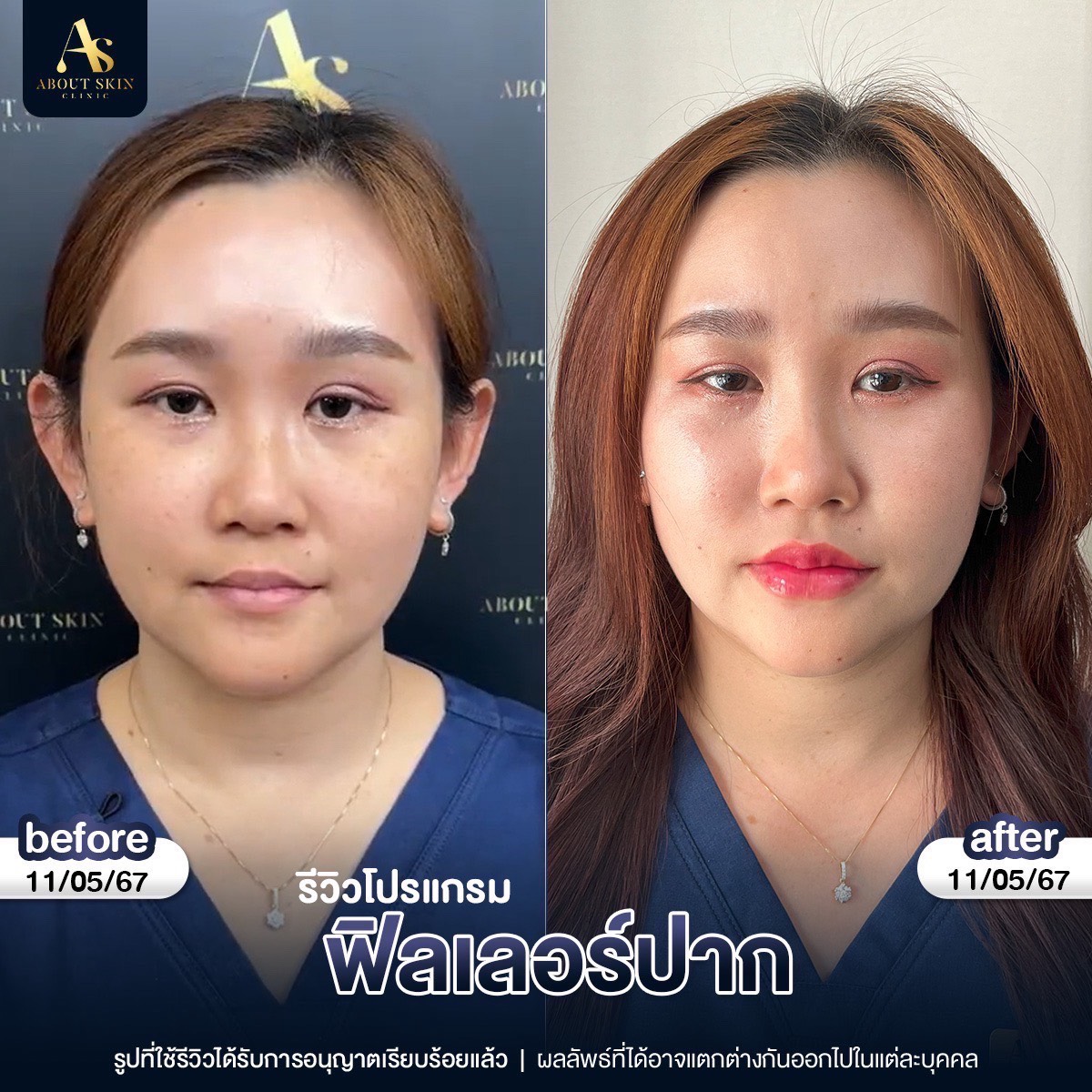 รีวิวโปรแกรมฟิลเลอร์ปาก About Skin Clinic