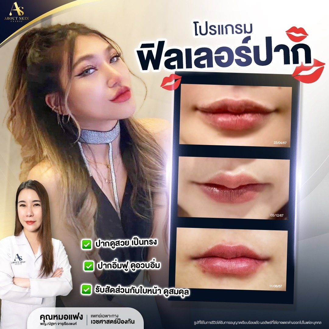 โปรแกรมฟิลเลอร์ปาก About Skin Clinic