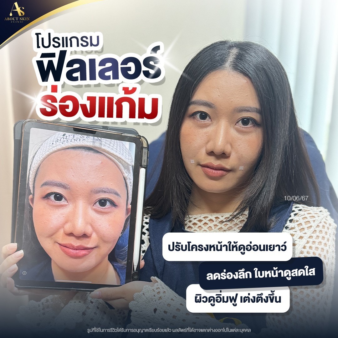 โปรแกรมฟิลเลอร์ร่องแก้ม About Skin Clinic
