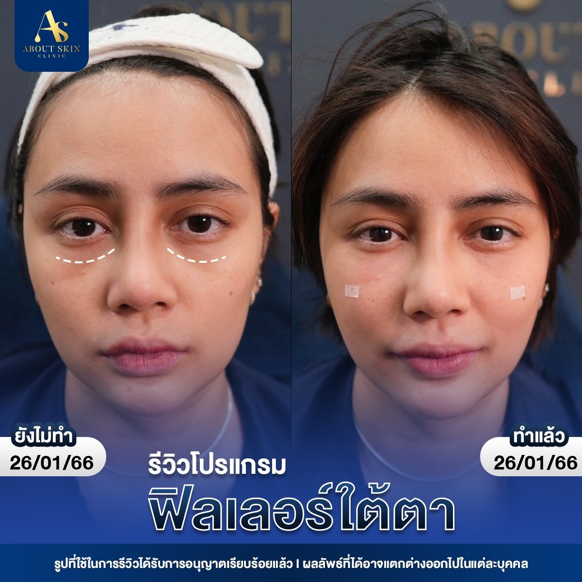 รีวิวโปรแกรมฟิลเลอร์ใต้ตา About Skin Clinic