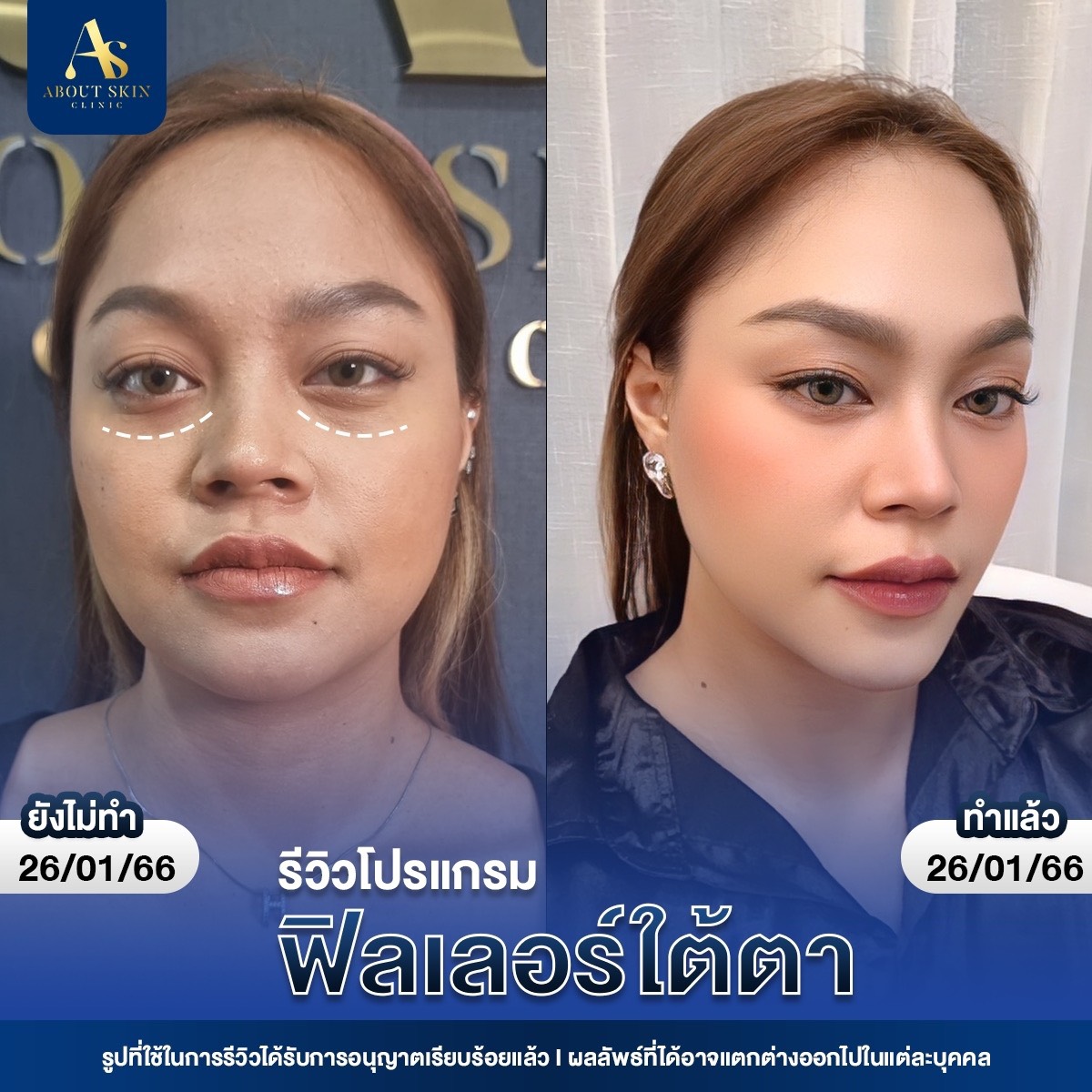 รีวิวโปรแกรมฟิลเลอร์ใต้ตา About Skin Clinic