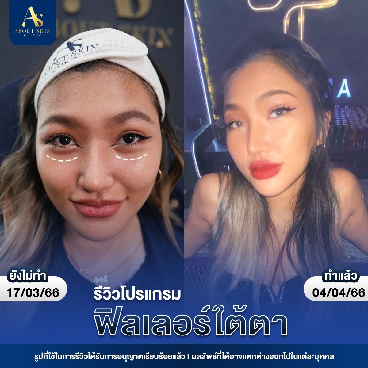รีวิวโปรแกรมฟิลเลอร์ใต้ตา About Skin Clinic