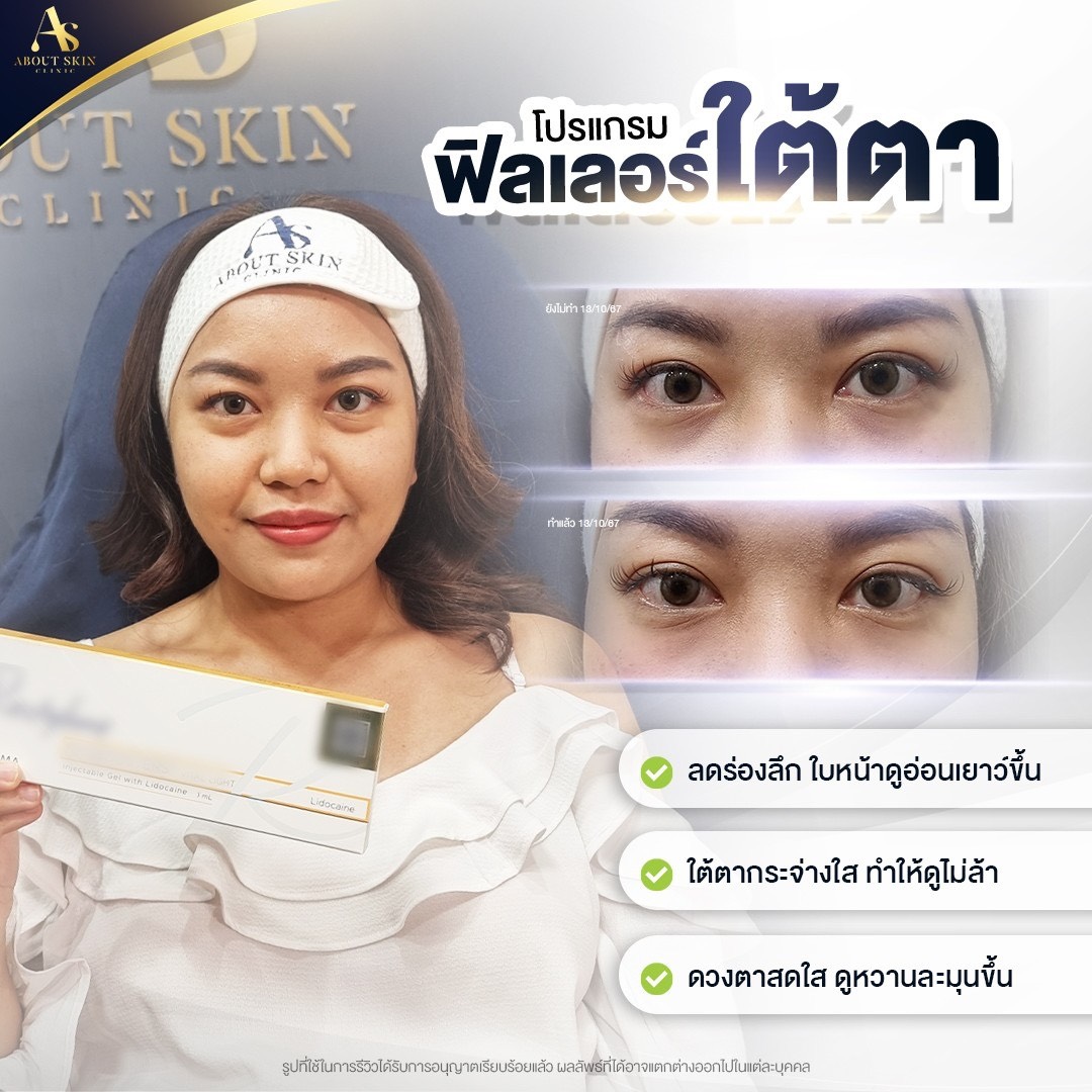 รีวิวโปรแกรมฟิลเลอร์ใต้ตา About Skin Clinic
