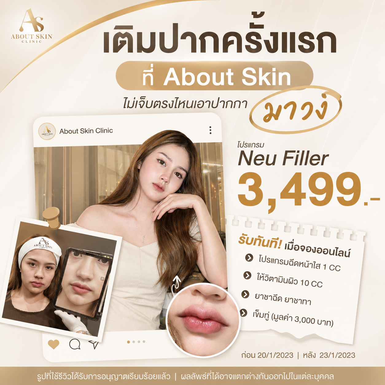 โปรแกรมฉีดฟิลเลอร์ปาก Neu Filler About Skin Clinic
