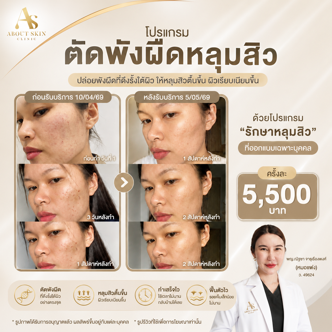 โปรแกรมตัดพังผืดหลุมสิว (Subcision) About Skin Clinic