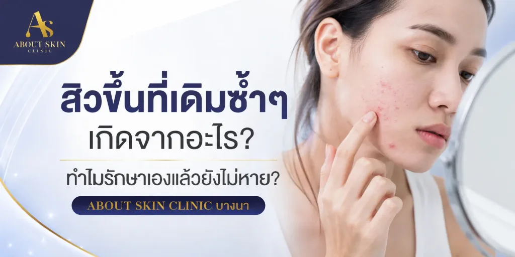 ภาพประกอบบทความ สิวขึ้นที่เดิมซ้ำๆ เกิดจากอะไร? ทำไมรักษาเองแล้วยังไม่หาย | About Skin Clinic บางนา - About Skin Clinic