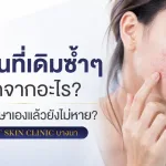 ภาพประกอบบทความ สิวขึ้นที่เดิมซ้ำๆ เกิดจากอะไร? ทำไมรักษาเองแล้วยังไม่หาย | About Skin Clinic บางนา - About Skin Clinic