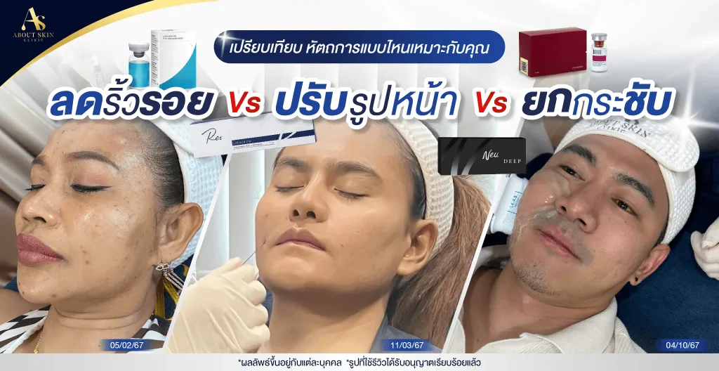ภาพประกอบบทความ เปรียบเทียบวิธีดูแลผิว - ลดริ้วรอย ปรับรูปหน้า กระชับผิว แบบไหนที่เหมาะกับคุณ? - About Skin Clinic