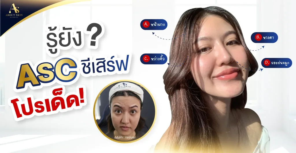 ภาพประกอบบทความ โปรแกรมฉีดโบท็อกซ์ลดริ้วรอย เพียง 1,990 บาท! - About Skin Clinic
