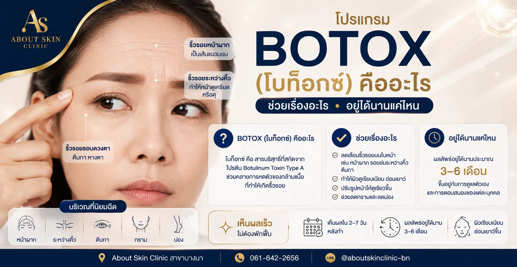 โบท็อกซ์ Botox ฉีดลดริ้วรอย