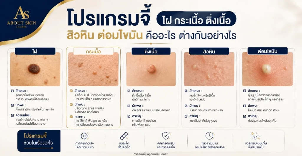 จี้ไฝ ติ่งเนื้อ กระเนื้อ ที่ About Skin Clinic สาขาบางนา
