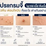 จี้ไฝ ติ่งเนื้อ กระเนื้อ ที่ About Skin Clinic สาขาบางนา