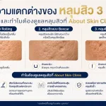 ภาพประกอบบทความ ความแตกต่างของหลุมสิว 3 แบบ และทำไมต้องดูแลหลุมสิวที่ About Skin Clinic - About Skin Clinic