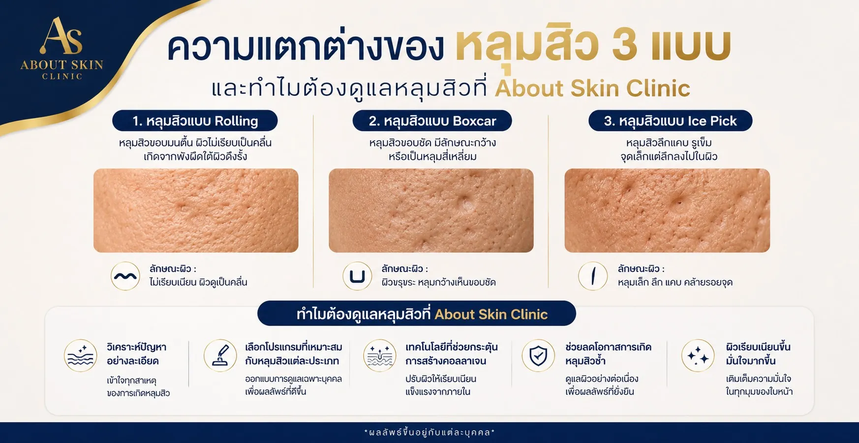 ภาพประกอบบทความ ความแตกต่างของหลุมสิว 3 แบบ และทำไมต้องดูแลหลุมสิวที่ About Skin Clinic - About Skin Clinic