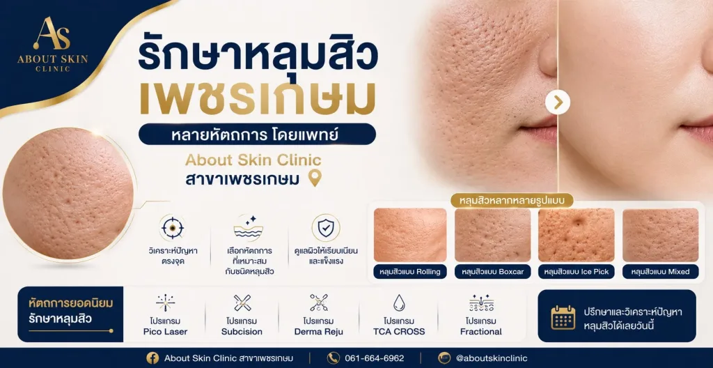 รักษาหลุมสิว เพชรเกษม
