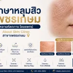 รักษาหลุมสิว เพชรเกษม