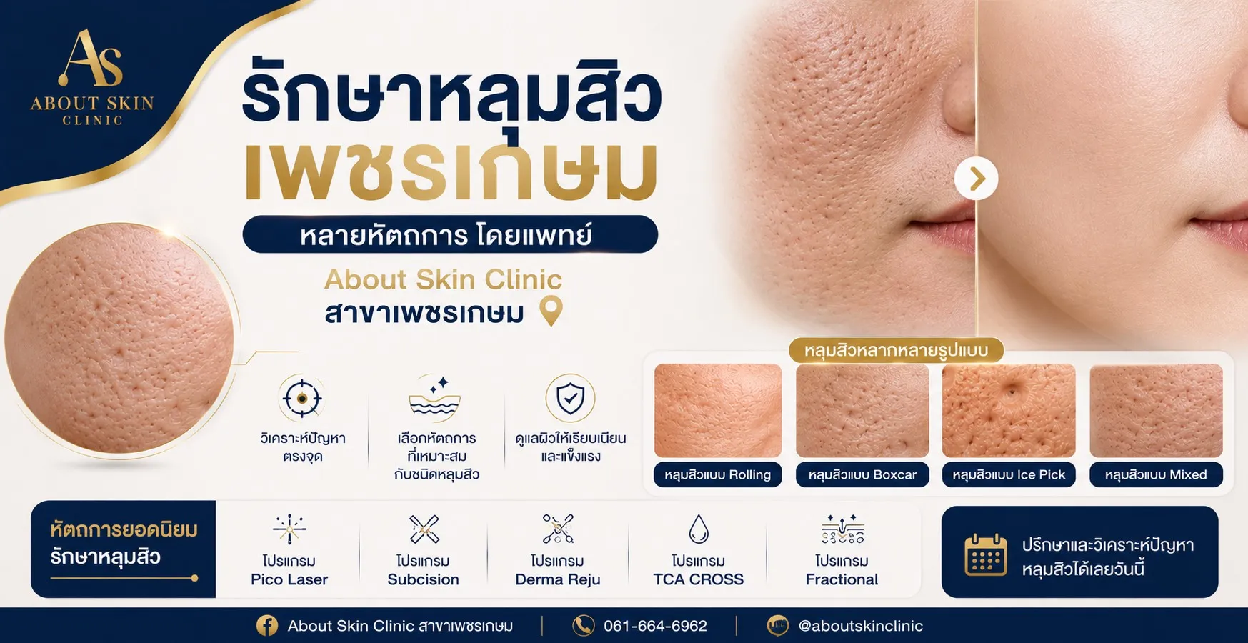 รักษาหลุมสิว เพชรเกษม