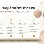 ภาพประกอบบทความ รักษาหลุมสิวแล้วหายถาวรไหม ผลลัพธ์อยู่ได้นานแค่ไหน - About Skin Clinic