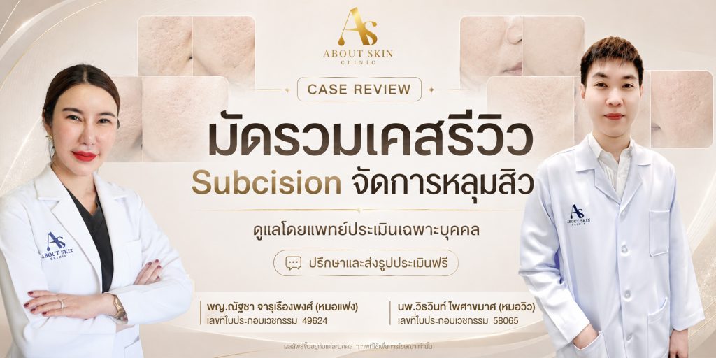 มัดรวมเคสรีวิว Subcision จัดการหลุมสิว About Skin Clinic