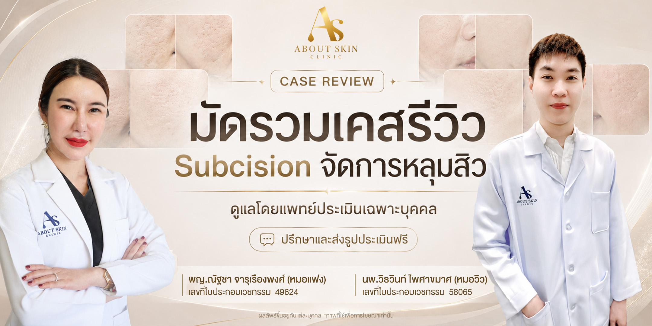 มัดรวมเคสรีวิว Subcision จัดการหลุมสิว About Skin Clinic