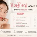 ภาพประกอบบทความ สิวผู้ใหญ่ คืออะไร ต่างจากสิววัยรุ่นอย่างไร - About Skin Clinic