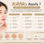 ภาพประกอบบทความ สิวใต้ผิว คืออะไร ทำไมกดไม่ออก บีบเองอันตรายไหม - About Skin Clinic